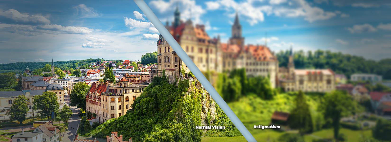 Astigmatism Treatment in Paris